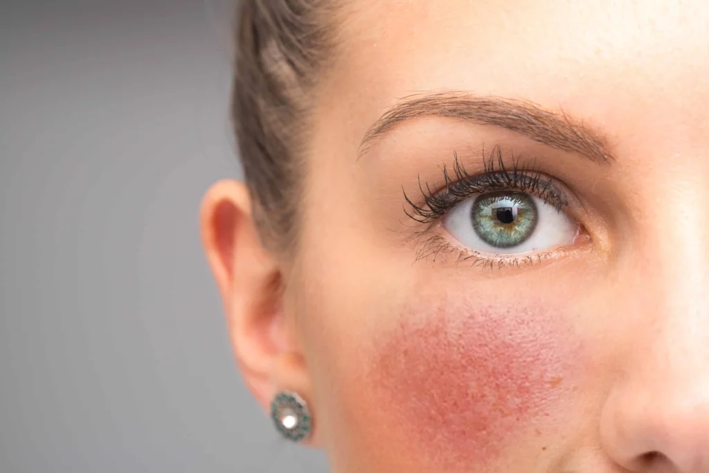 IPL Vascular Treatment by Bellus Medical Aesthetics in Minot, ND