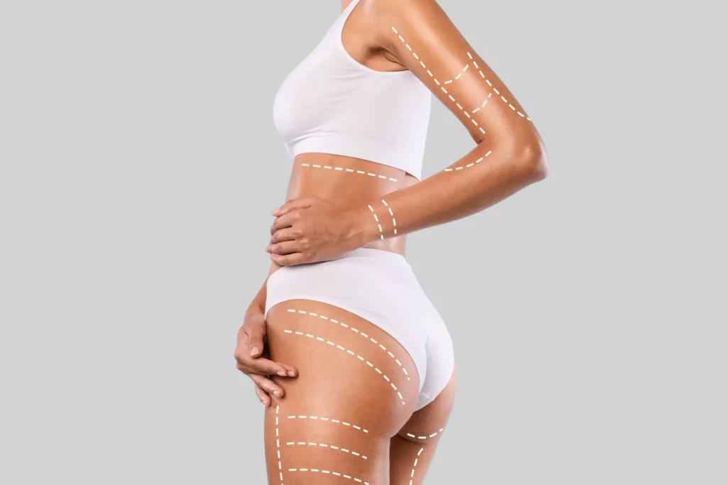 Endolift Body by Bellus Medical Aesthetics in Minot, ND