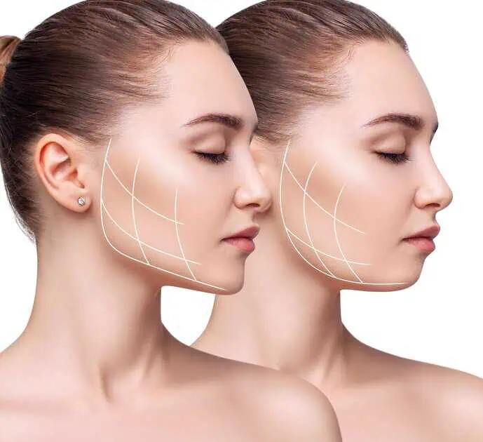 Endolift Facelift in Minot, ND by Bellus Medical Aesthetics