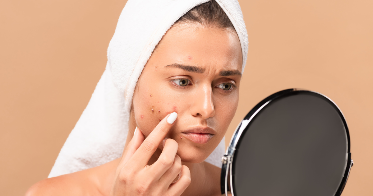 Woman examining acne in mirror before IPL acne treatment in Minot, ND