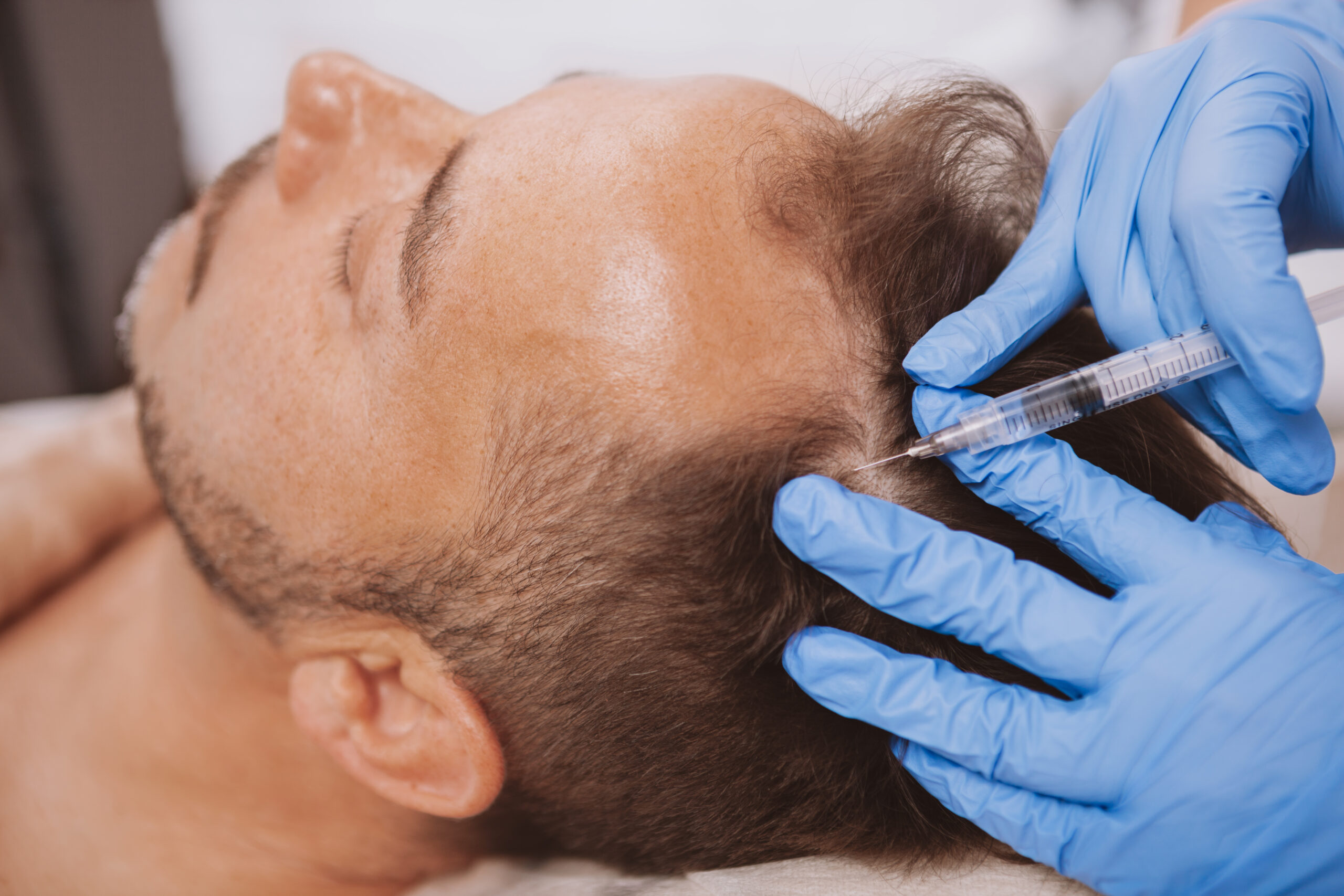 Hair Restoration Treatment by Bellus Medical Aesthetics in Minot, ND