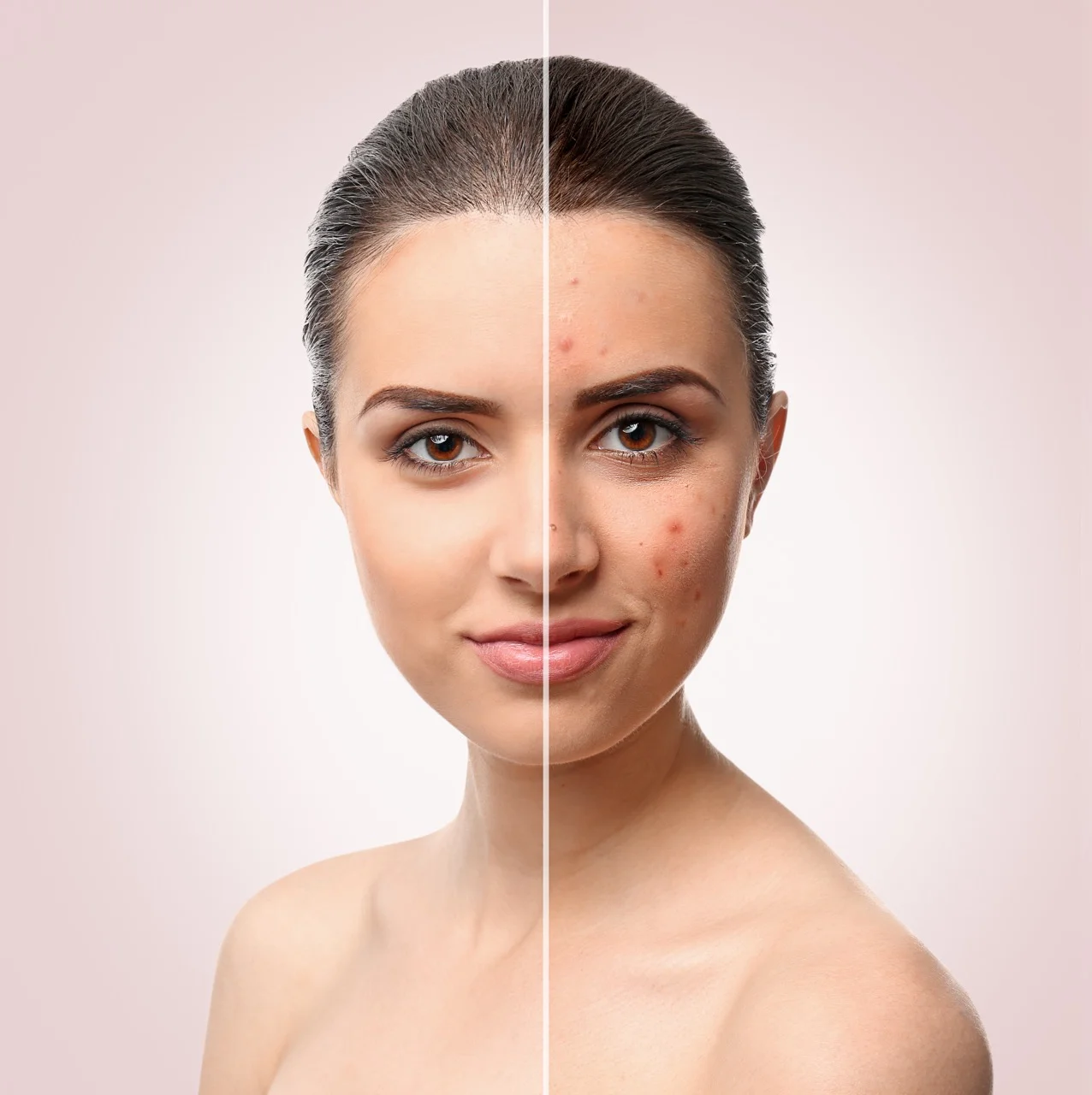 IPL Acne Treatment by Bellus Medical Aesthetics in Minot, ND